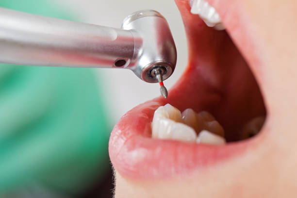 Best Emergency Dentist for Lost Fillings or Crowns in Ojus, FL